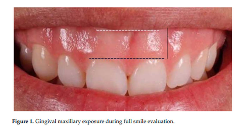 ガミースマイルの例、歯肉露出